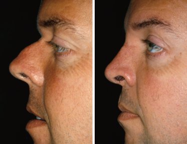 Vorher-nachher-Ergebnisse der Nasenkorrektur bei Männern in der Cairo Plastic Clinic