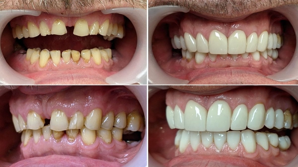 نتائج قبل وبعد طقم الأسنان في Smile Centrum – ابتسامة محسنة وترميم الأسنان
