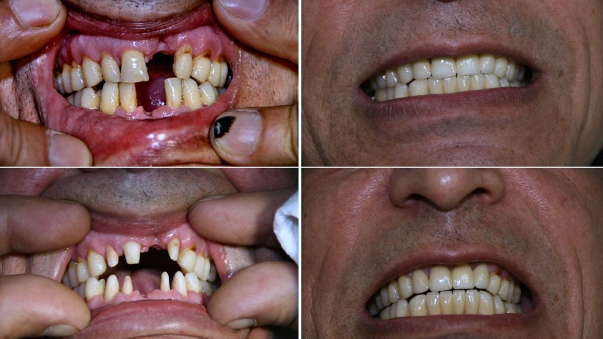 Resultados antes y después de dentaduras en Smile Centrum: restauración total de la sonrisa