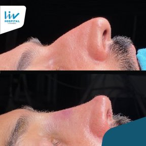 Vorher-nachher-Rhinoplastik-Ergebnisse bei Liv Hospital Vadistanbul, verbesserte Nasenform