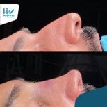 Vorher-nachher-Rhinoplastik-Ergebnisse bei Liv Hospital Vadistanbul, verbesserte Nasenform