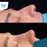 Vorher-nachher-Ergebnis der Nasenkorrektur in Liv Hospital Vadistanbul, verbesserte Nasenform