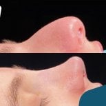 Vorher-nachher-Ergebnis der Nasenkorrektur in Liv Hospital Vadistanbul, verbesserte Nasenform