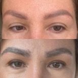 Before and after eyebrow transplantation result at Dr. MED – fuller, natural-looking brows
