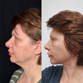 Before and after neck lift results at Dr. Safa Manav Clinic, improved jawline definition