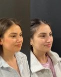 نتائج تجميل الأنف قبل وبعد في مجمع مستشفى ميديكال بارك أنطاليا، إعادة تشكيل الأنف