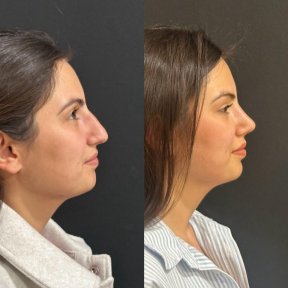 نتائج عملية تجميل الأنف قبل وبعد في مجمع ميديكال بارك أنطاليا، إعادة تشكيل الأنف