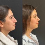 نتائج عملية تجميل الأنف قبل وبعد في مجمع ميديكال بارك أنطاليا، إعادة تشكيل الأنف
