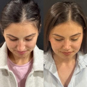 نتائج عملية تجميل الأنف قبل وبعد في مجمع ميديكال بارك أنطاليا، إعادة تشكيل الأنف