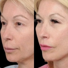 Facelift Vorher-Nachher-Ergebnisse im Medical Park Antalya Hospital Complex, Verjüngung