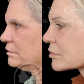 Facelift Vorher-Nachher-Ergebnisse in Medical Park Antalya, sichtbare Gesichtsverjüngung