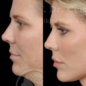 Facelift Vorher-Nachher-Ergebnisse im Medical Park Antalya Hospital Complex, sichtbare Straffung