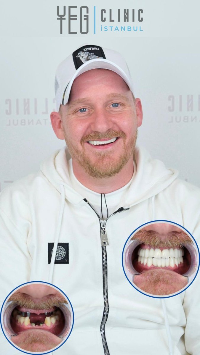 Resultado antes y después de implantes dentales All-on-4 en YEG Clinic Estambul