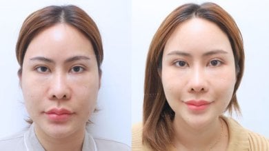 نتيجة تجديد شباب الوجه بالخلايا الجذعية قبل وبعد في مستشفى وانسيري