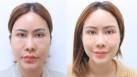 نتيجة تجديد شباب الوجه بالخلايا الجذعية قبل وبعد في مستشفى وانسيري