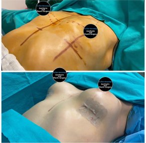 Vorher-nachher-Ergebnisse Brustvergrößerung in Dr. Ilker Manavbasi's Klinik, verbesserte Kontur
