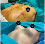 Vorher-nachher-Ergebnisse Brustvergrößerung in Dr. Ilker Manavbasi's Klinik, verbesserte Kontur