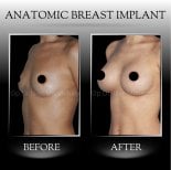 نتائج تكبير الثدي قبل وبعد في عيادة د. إلكر مانافباشي، شكل محسن