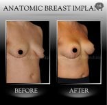 نتائج تكبير الثدي قبل وبعد في عيادة د. إيلكر مانافباشي باستخدام الزرعات