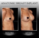 نتائج تكبير الثدي قبل وبعد في عيادة د. إيلكر مانافباشي، ثدي ممتلئ