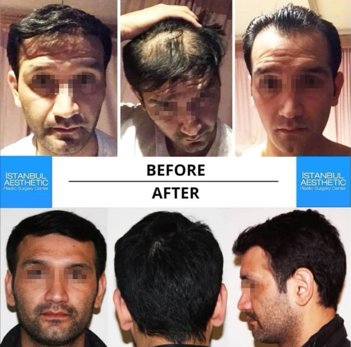 Vorher-nachher-Ergebnis Haartransplantation bei Istanbul Aesthetic Plastic Surgery Center, volleres Haar