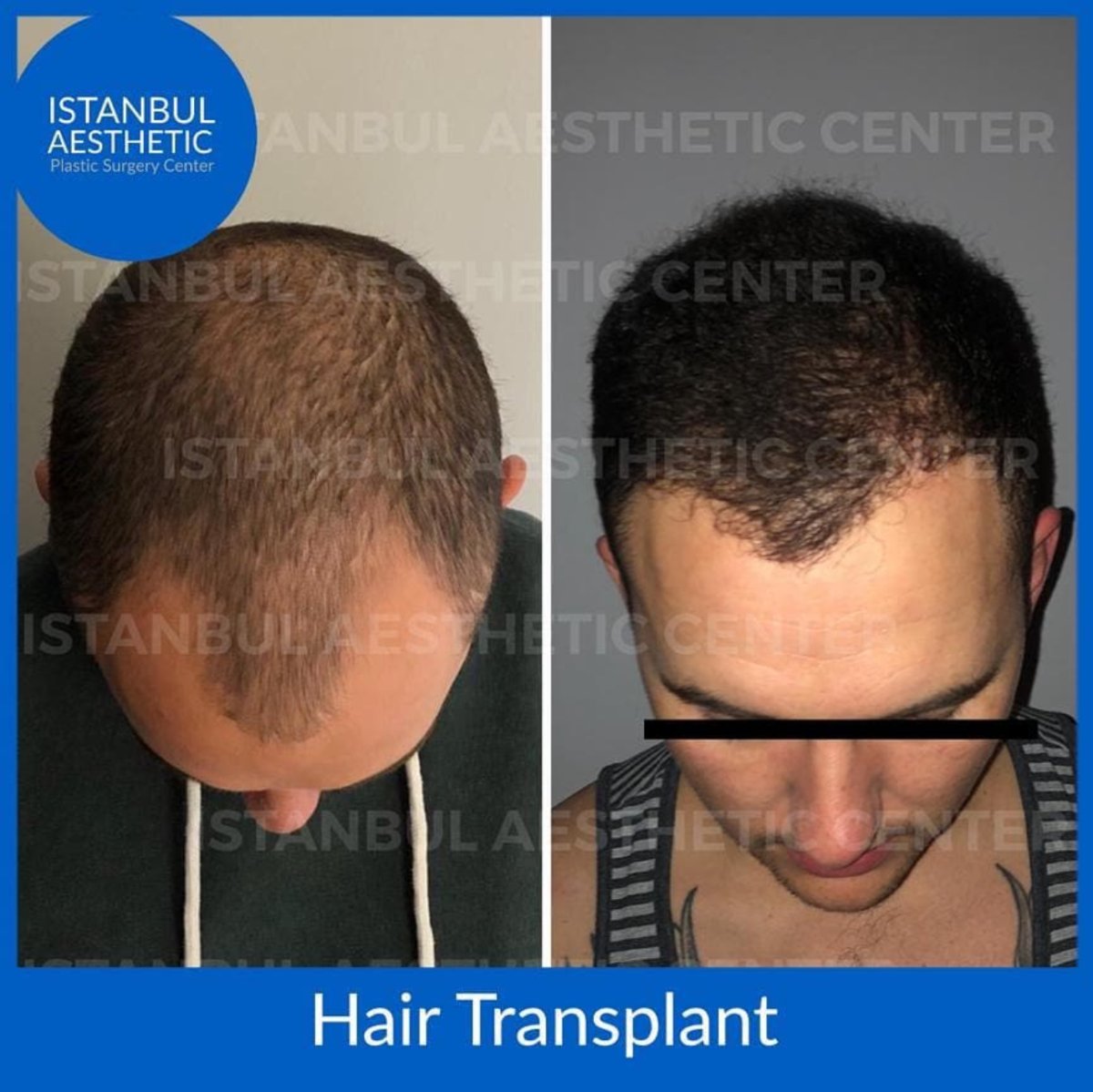 Vorher-nachher-Ergebnis der Haartransplantation im Istanbul Aesthetic Plastic Surgery Center, volleres Haar