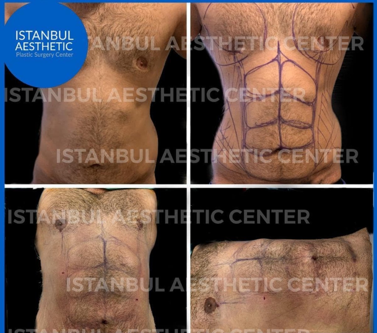 Результаты Vaser липосакции до и после в Istanbul Aesthetic Plastic Surgery Center, мужской пресс