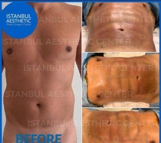 Результаты до и после Vaser липосакции в Istanbul Aesthetic, контурирование пресса