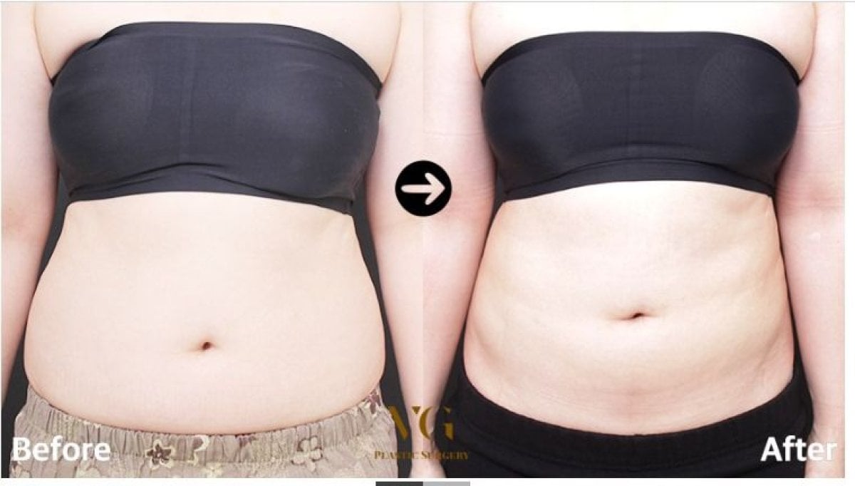 نتائج شد البطن وشفط الدهون قبل وبعد في VG Plastic Surgery، بطن أكثر تسطحًا
