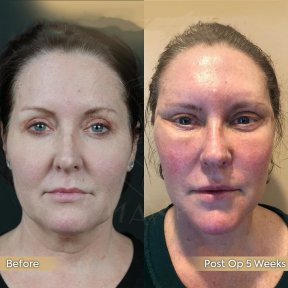 Vorher-nachher-Ergebnis Brauenlifting bei Dr. Safa Manav Clinic, Stirnlift nach 5 Wochen