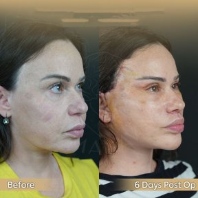 Vorher-nachher-Ergebnis Brauenlifting bei Dr. Safa Manav Clinic, sichtbare Augenverjüngung