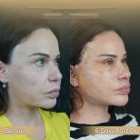 Vorher-nachher-Ergebnis Brauenlifting bei Dr. Safa Manav Clinic, sichtbare Augenverjüngung