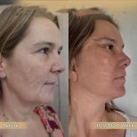 Vorher-nachher-Ergebnis Brauenlifting bei Dr. Safa Manav Clinic, sichtbare Verjüngung