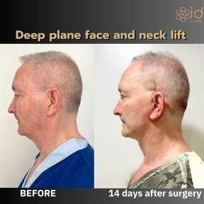 Before and after deep plane facelift and neck lift results at ID Clinic Bangkok, 14 days post-op