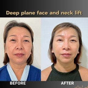 Before and after deep plane facelift and neck lift results at ID Clinic Bangkok