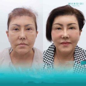 Before and after deep plane facelift results at Wansiri Hospital, facial rejuvenation visible