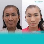 Before and after deep plane facelift results at Wansiri Hospital, facial rejuvenation procedure