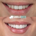 Before and after dental bonding results at SmileBox Dental Clinic - Thonglor, Sukhumvit Branch