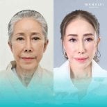 Before and after deep plane facelift results at Wansiri Hospital, facial rejuvenation procedure