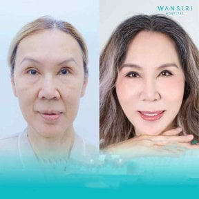 Before and after deep plane facelift results at Wansiri Hospital, facial rejuvenation visible