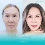 Before and after deep plane facelift results at Wansiri Hospital, facial rejuvenation visible
