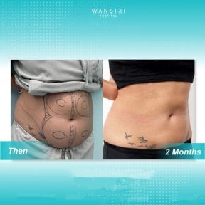 Resultados de liposucción 360 antes y después en Wansiri Hospital, mejora visible del contorno corporal