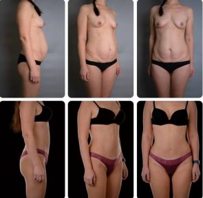 نتائج شد البطن قبل وبعد في Yurchenko Plastic Surgery Team Kyiv، بطن مسطح