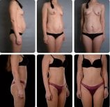 نتائج شد البطن قبل وبعد في Yurchenko Plastic Surgery Team Kyiv، بطن مسطح