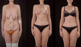 نتائج شد البطن قبل وبعد في Yurchenko Plastic Surgery Team Kyiv، تحسين شكل الجسم