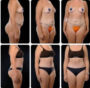 نتائج شد البطن قبل وبعد في Yurchenko Plastic Surgery Team Kyiv، تحسين شكل البطن