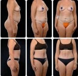 نتائج شد البطن قبل وبعد في Yurchenko Plastic Surgery Team Kyiv، تحسين شكل البطن