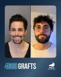 Resultado de trasplante de barba con 4600 injertos antes y después en Smile Hair Clinic Turquía