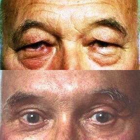 Vorher-nachher-Ergebnis der Blepharoplastik in der Cairo Plastic Clinic, Lidkorrektur