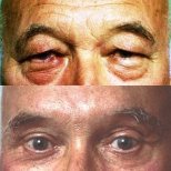 Vorher-nachher-Ergebnis der Blepharoplastik in der Cairo Plastic Clinic, Lidkorrektur